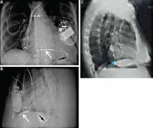 Normal lead positions in a cardiac resynchronization therapy defibrillator device on a posteroanterior chest radiograph