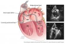 Correctly positioned and malpositioned leads