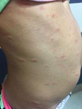 Multiple scaly, pink, oval plaques and papules on the 6-year-old female patient's torso are pityriasis rosea lesions.