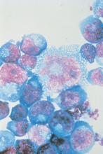 HIV-infected T cells are shown under high magnification.