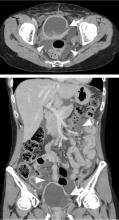 Figure 1. Contrast-enhanced computed tomography of the abdomen showed massive ascites (arrowheads) and irregularity in the bladder wall (arrow).