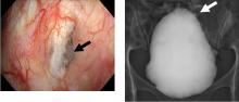 Figure 2. Left, cystoscopy showed thinning of the bladder wall with a fistula (black arrow). Right, cystography showed intraperitoneal leakage of contrast medium from the bladder (white arrow).