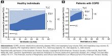 Figure 2. Changes in operational lung volumes shown as ventilation increases in (A) healthy individuals and (B) patients with COPD.