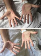 Figure 1. The patient’s hands on presentation (top) and after treatment with intravenous methylene blue (bottom).