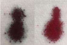 Figure 2. The patient’s arterial blood on presentation (left) compared with a sample of normal arterial blood (right).