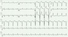 A 12-lead electrocardiogram from a 70-year-old woman with a 12-month history of progressive exertional dyspnea