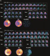 Pharmacologic nuclear myocardial perfusion imaging in a 75-year-old woman with atypical symptoms and resting left bundle branch block on electrocardiography