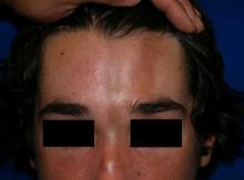 morphea lesion on the teen male's forehead