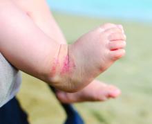 newborn's feet with eczema