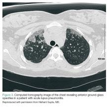 Complications of Systemic Lupus Erythematosus in the Emergency ...