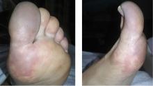 Acrocyanosis of the left hallux with an acral distribution.