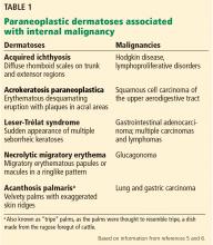 Paraneoplastic dermatoses associated with internal malignancy