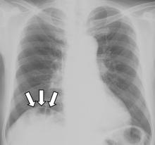 Radiography of the chest with the patient standing showed gas under the right diaphragm (arrows).