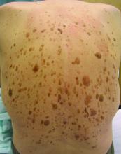 Seborrheic keratoses on an individual's back.