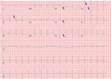 The patient’s electrocardiogram on presentation.