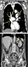 Computed tomography (CT) with a chest pulmonary embolism protocol showed filling defects.