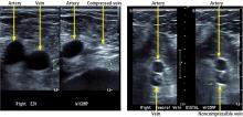  Example of lower-extremity duplex ultrasonography. 