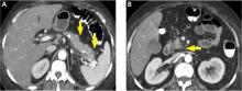 Acute edematous interstitial pancreatitis.