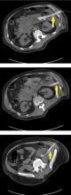 Treatment of infected walled-off necrosis in the patient shown in Figure 3.