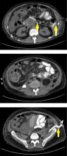 Further treatment of infected walled-off necrosis in the patient shown in Figures 3 and 4.