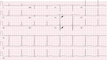 The patient’s electrocardiogram showed new biphasic T-wave inversions in leads V2 and V3 (arrows), normal precordial R-wave progression, and absent Q waves.