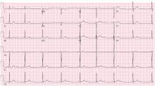 Electrocardiography 7 months later showed resolution of T-wave inversions.