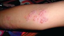 Herpes zoster on a patient's elbow