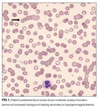 Patient’s peripheral blood smear shows moderate rouleaux formation (arrow) and increased background staining secondary to hypergammaglobulinemia.