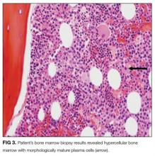 Patient’s bone marrow biopsy results revealed hypercellular bone marrow with morphologically mature plasma cells (arrow).