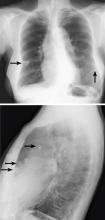 Chest radiography frontal and lateral views showed lesions suggesting pulmonary nodules.