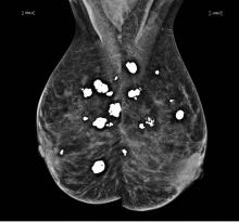 Mammography confirmed the presence of lesions in both breasts.