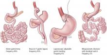 Most common metabolic surgical procedures.