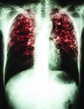 Mycobacterium tuberculosis infection (Pulmonary Tuberculosis)