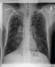 xray of cystic fibrosis