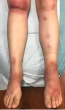 Erythematous tender nodules and plaques on the shins