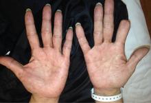 Well-circumscribed, reddish papular eruptions and papulosquamous lesions on the palms.