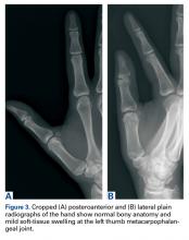 Multimodality Approach to a Stener Lesion: Radiographic, Ultrasound ...