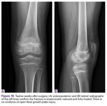 Knotless Arthroscopic Reduction And Internal Fixation Of A Displaced Anterior Cruciate Ligament Tibial Eminence Avulsion Fracture Mdedge Surgery