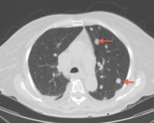 CT showed scattered solid pulmonary nodules (arrows) consistent with metastasis