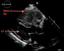 Two-dimensional transthoracic echocardiography