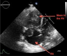 Two-dimensional transthoracic echocardiography (apical 4-chamber view)