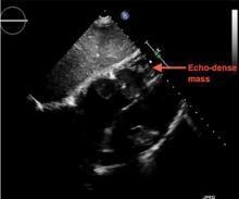 Two-dimensional transthoracic echocardiography (subcostal view)