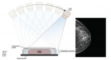 Schematic representation of image acquisition with breast tomosynthesis