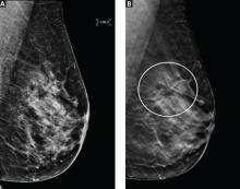 Example of masking by overlapping layers of breast tissue