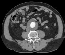 CT scan shows a 6.5-cm abdominal aortic aneurysm with a 3-cm lumen.