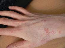 Scabies on right hand, wrist, and arm