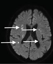 Figure 2. Axial diffusion-weighted magnetic resonance imaging on hospital day 5 showed multiple lesions with high signal intensity in both cerebral hemispheres (arrows).