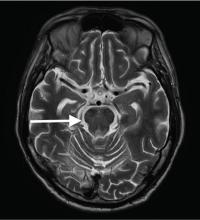 Figure 3. Axial T2-weighted magnetic resonance imaging repeated several months after presentation showed an improved lesion in the pons (arrow).