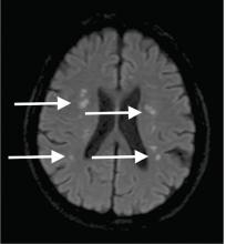 Figure 4. On diffusion-weighted magnetic resonance imaging several months after presentation, the multiple lesions in both hemispheres (arrows) were almost unchanged.