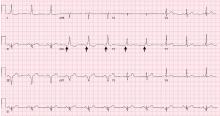 Figure 1. Electrocardiogram showing normal sinus rhythm with delta waves, most pronounced in lead V2 (arrows).